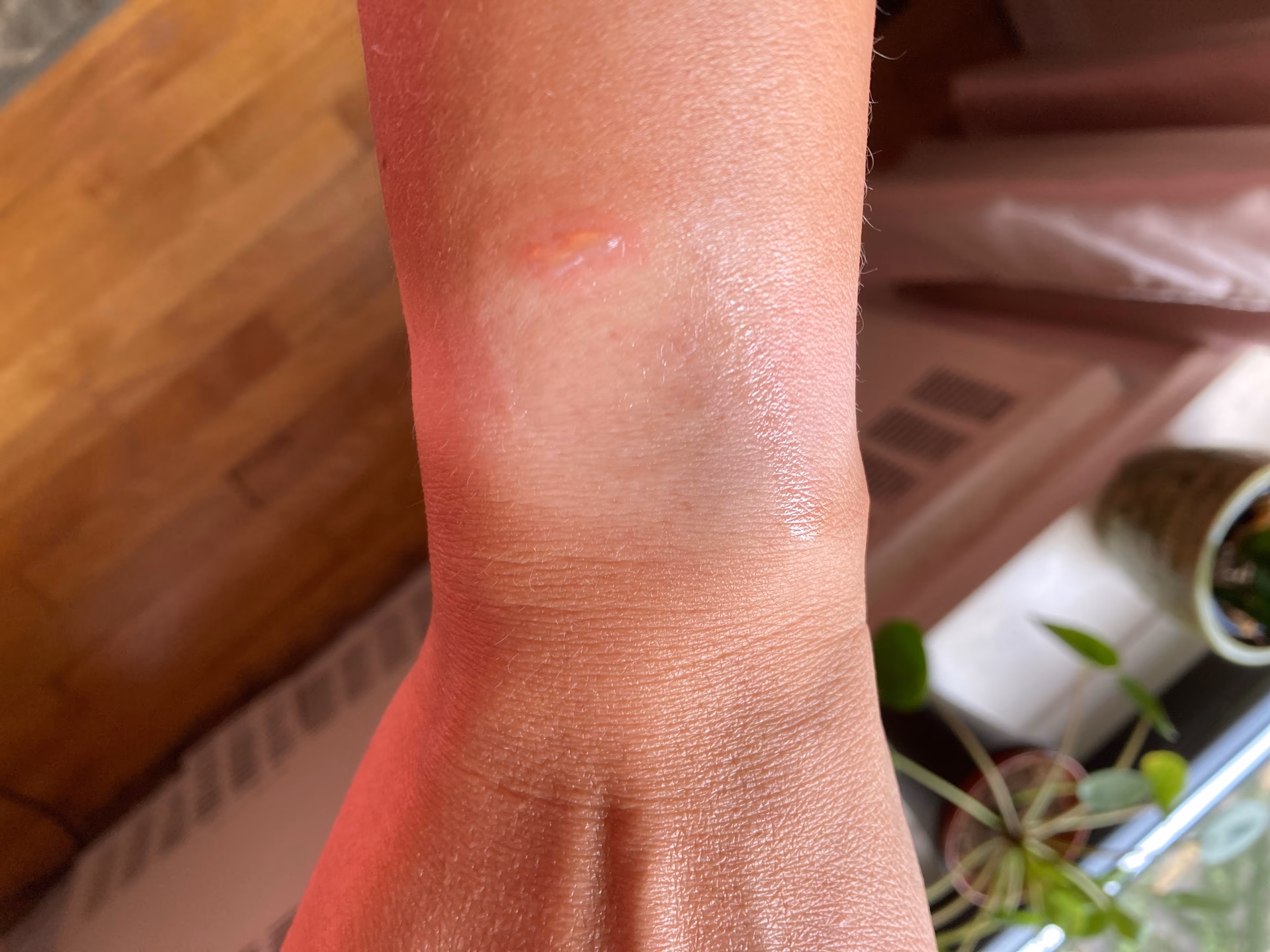 What causes a nickel allergic reaction?