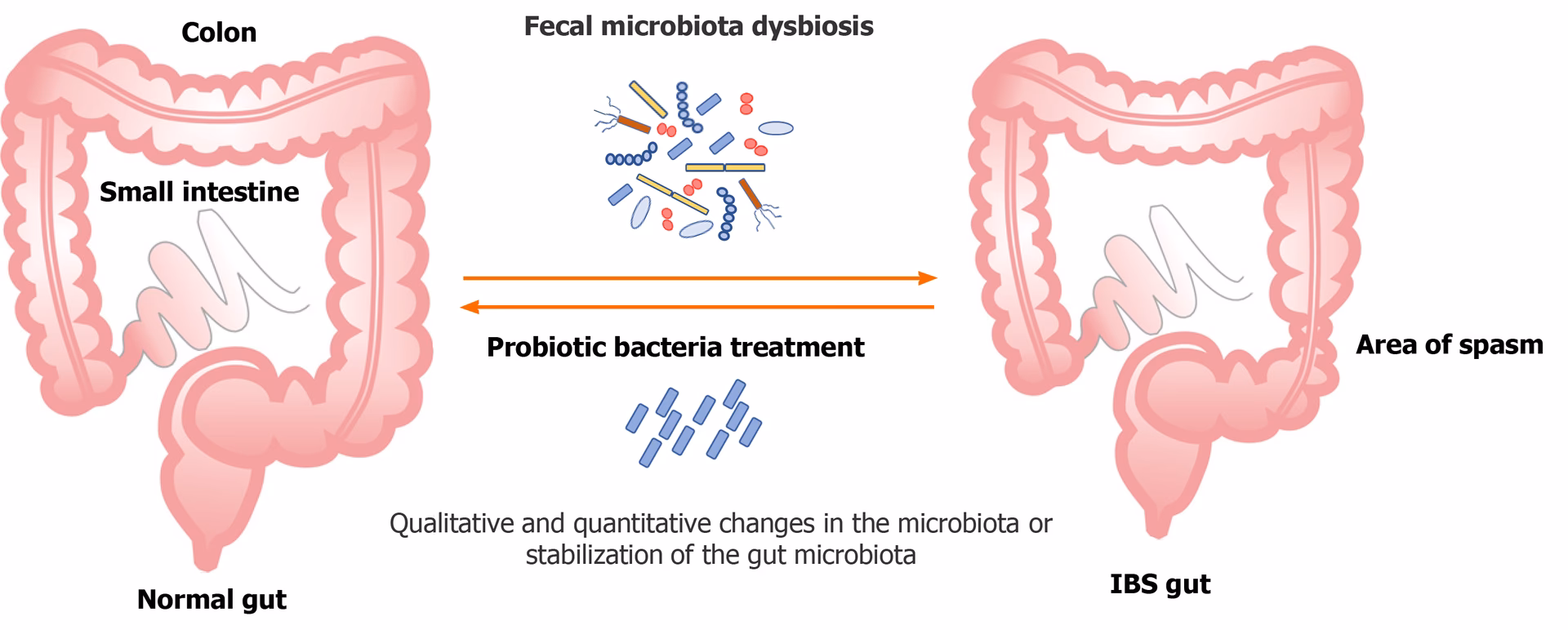 Does multispecies probiotic supplementation help irritable bowel syndrome?