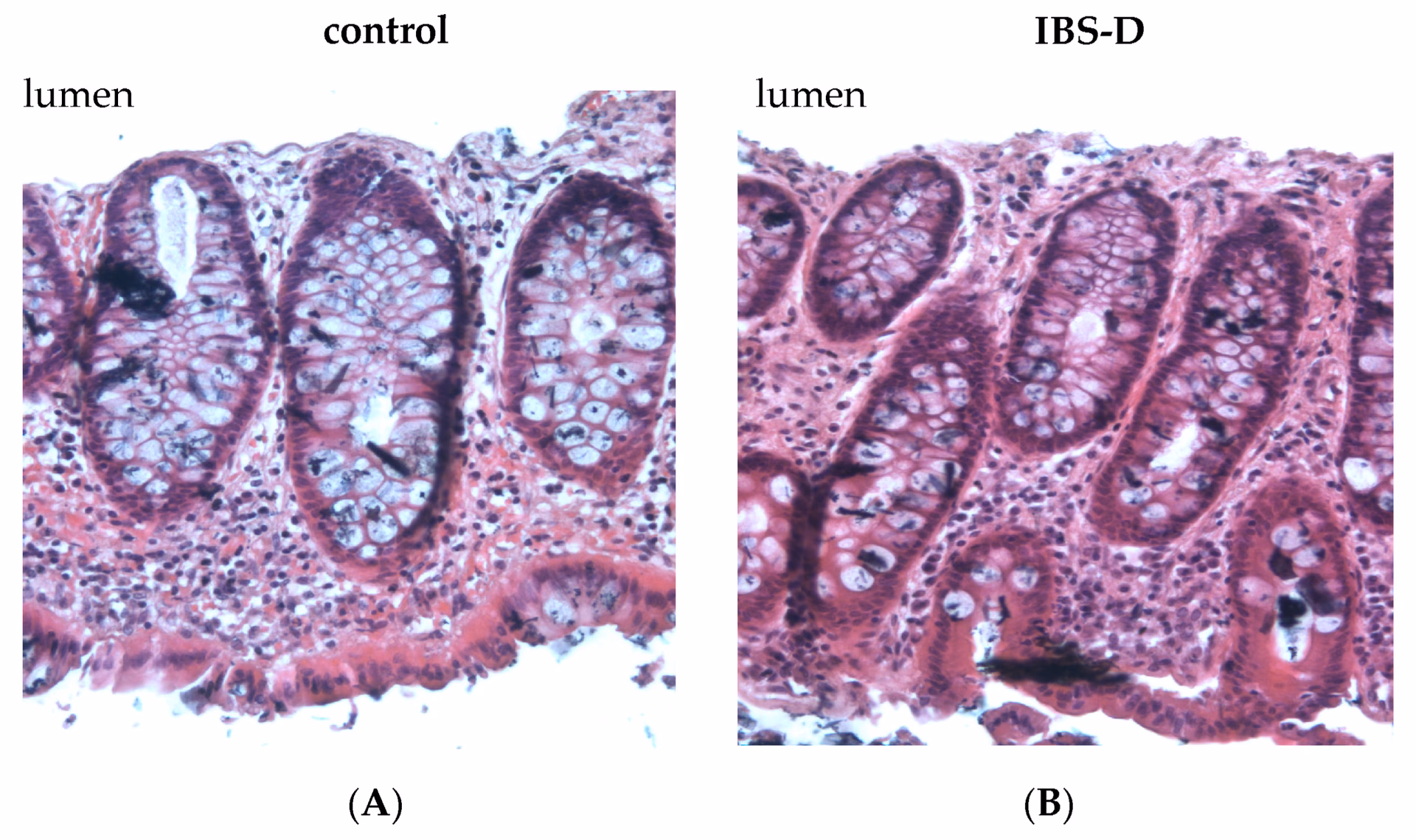 What is irritable bowel syndrome (IBS)?