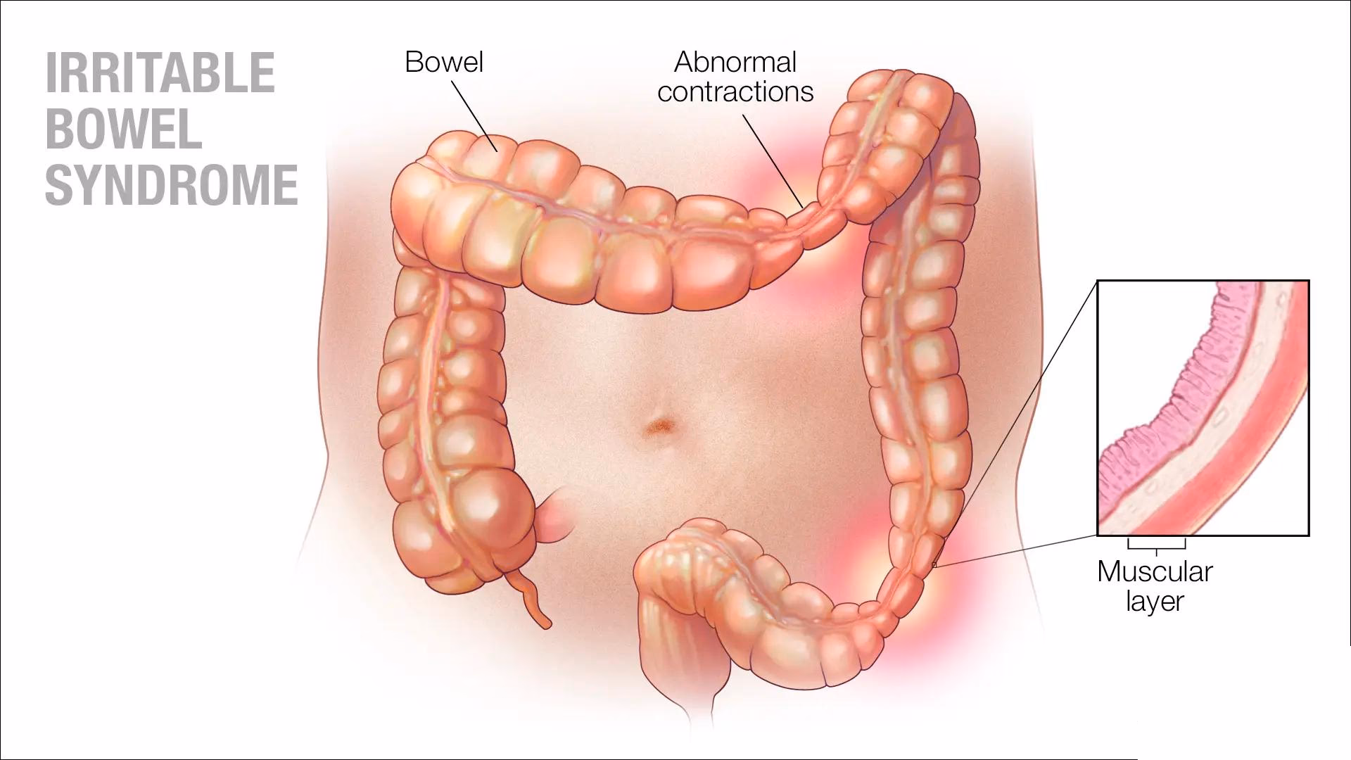 Can irritable bowel syndrome be cured?
