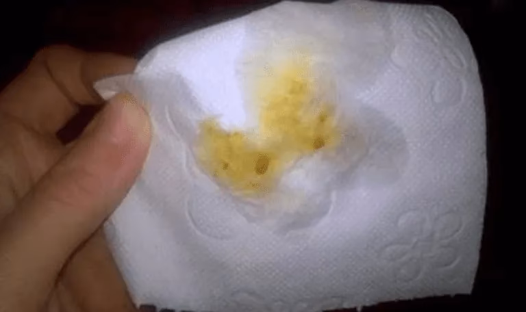 Is yellow or white mucus a symptom of IBS?