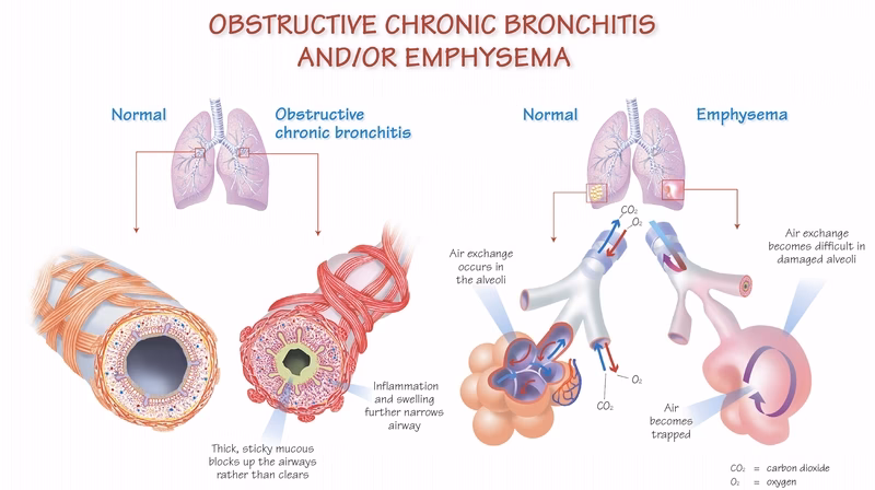 What is chronic bronchitis?