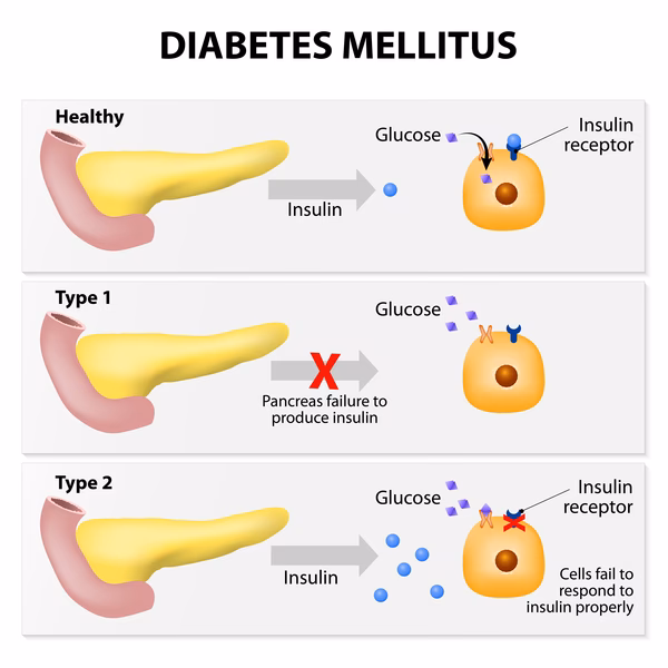 Is type 1 diabetes genetic?