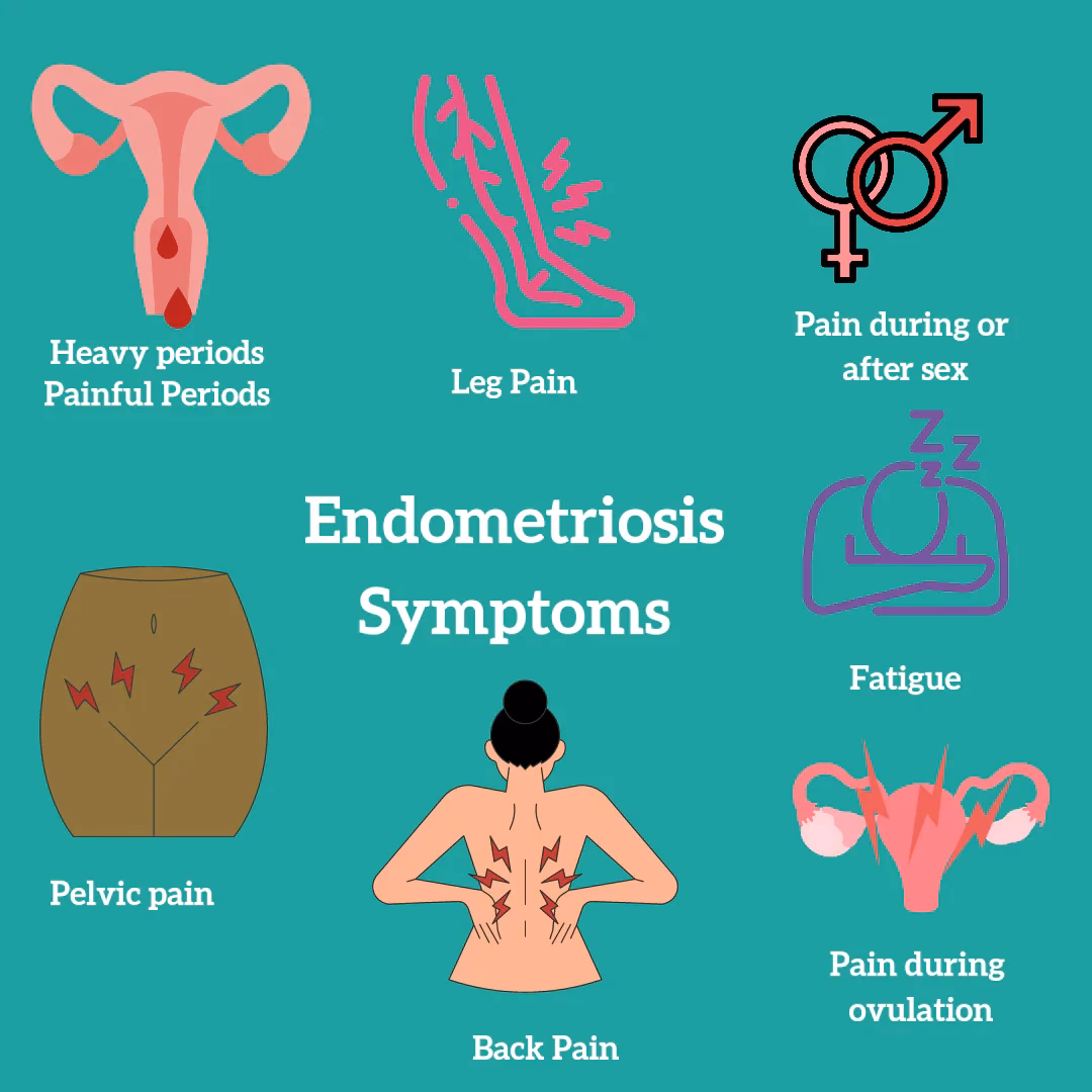 Is period pain a sign of endometriosis?