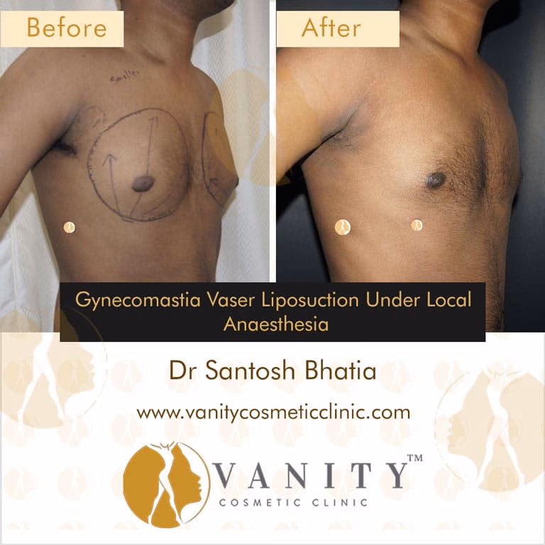 Can gynecomastia be corrected by liposuction?