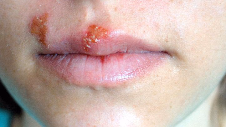 What is herpes simplex virus (HSV)?