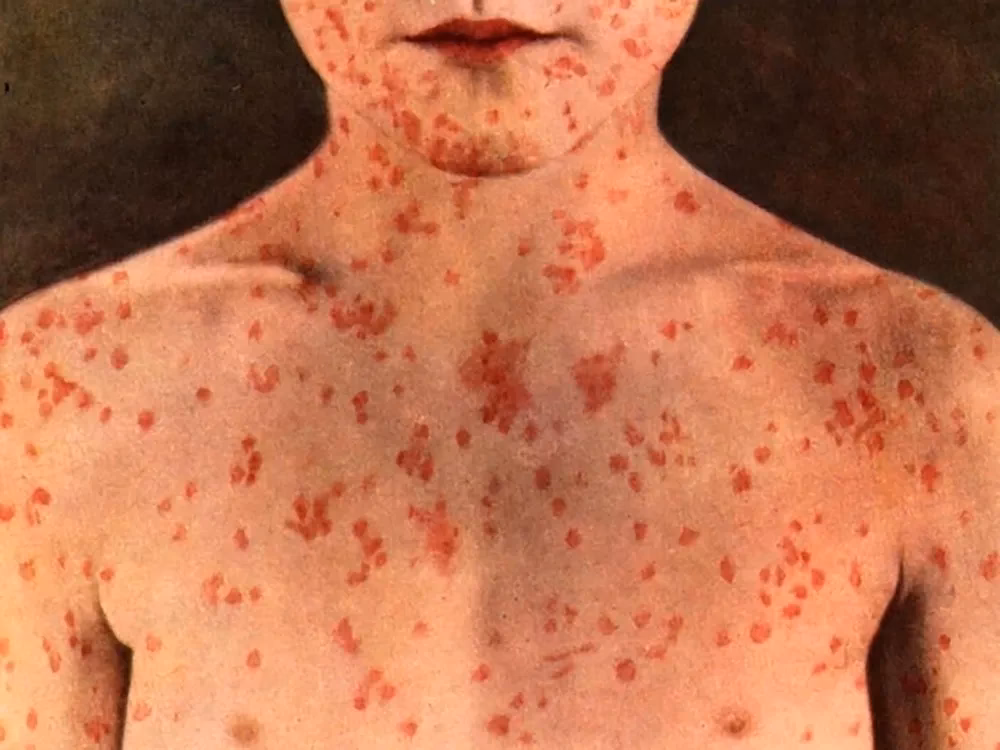What should I do if I get measles in Ontario?