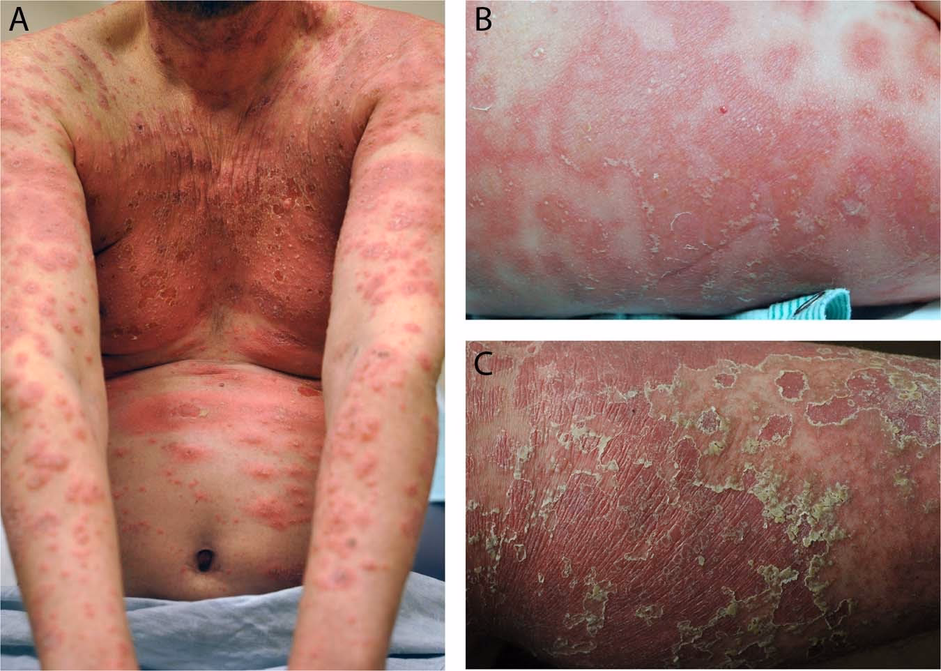 Is psoriasis hereditary?
