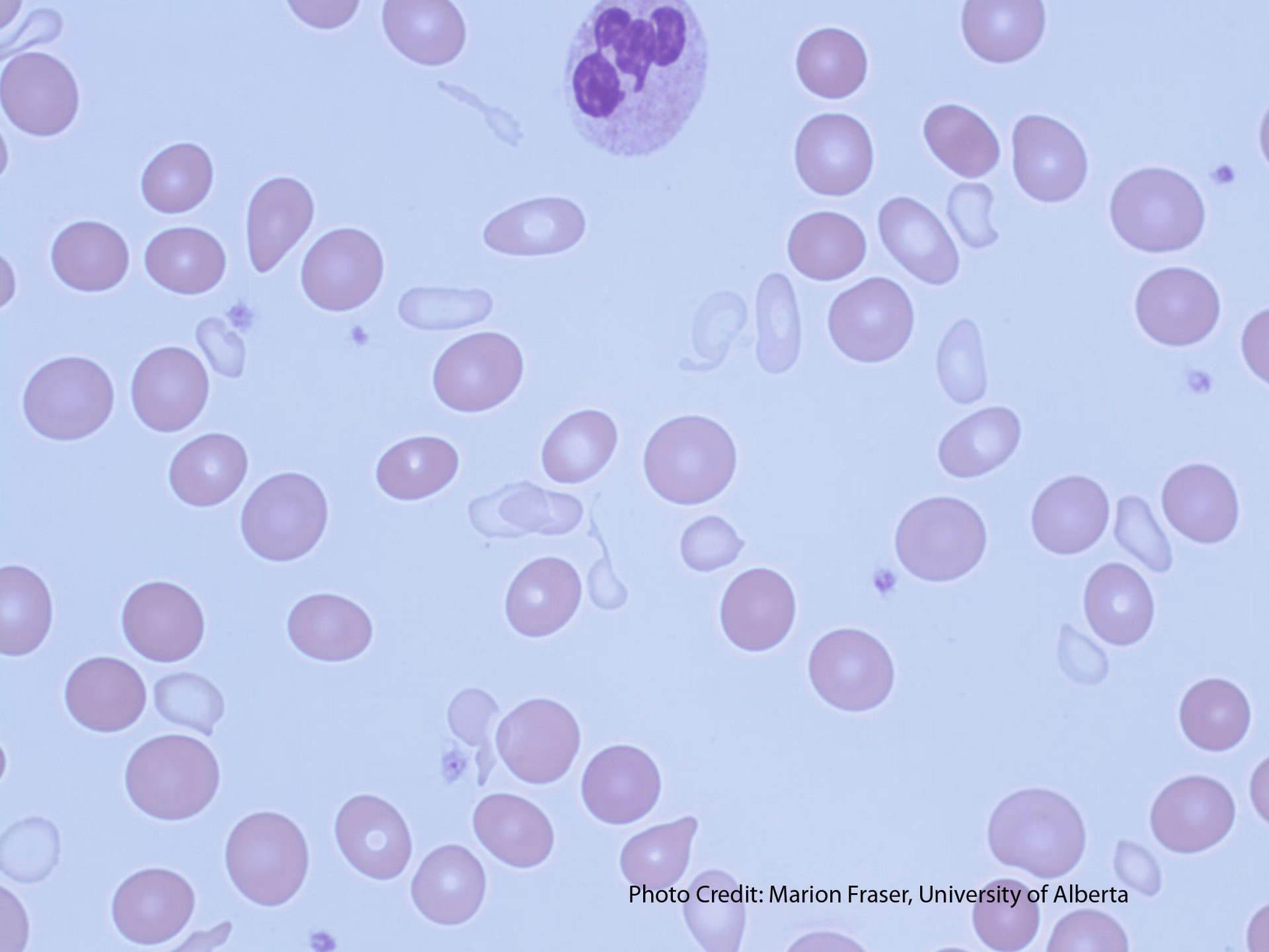 How do you know if you have sideroblastic anemia?