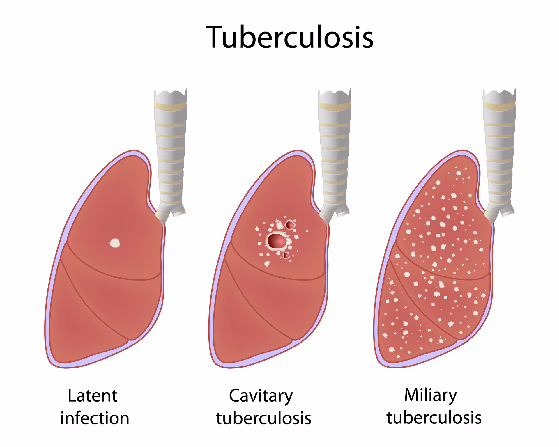 Are people with latent TB contagious?