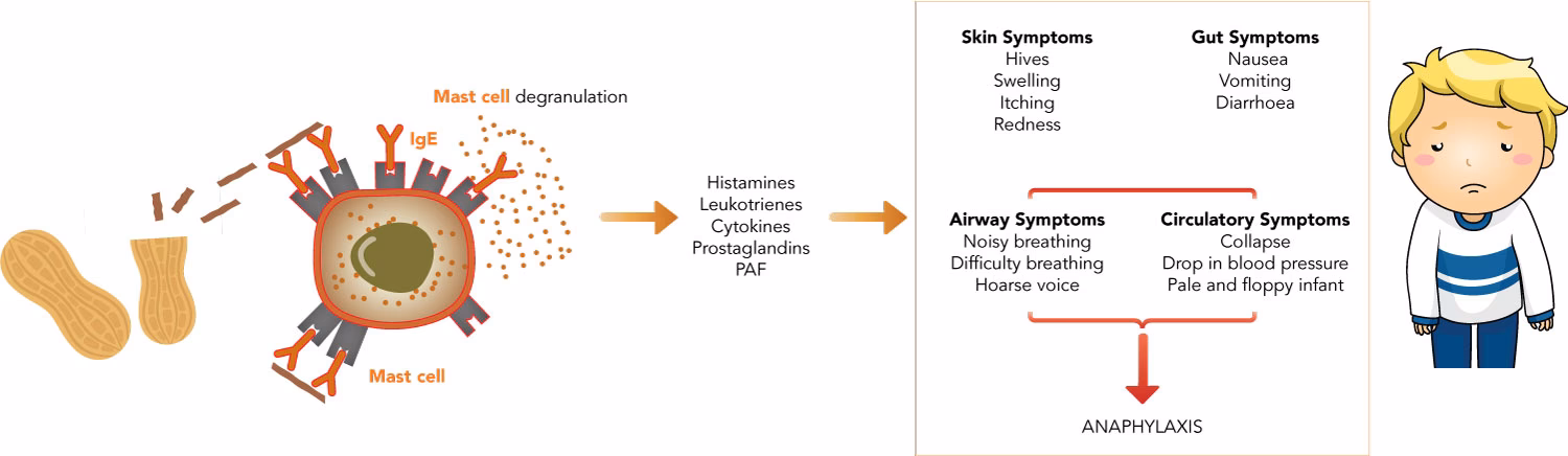 Can AIT help treat food allergies?