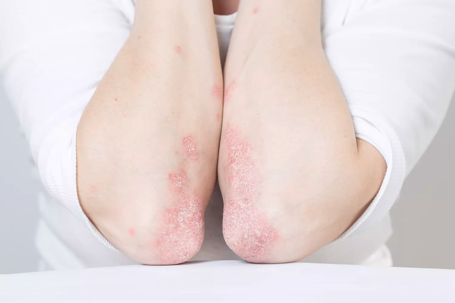 Quels sont les symptômes du psoriasis ?