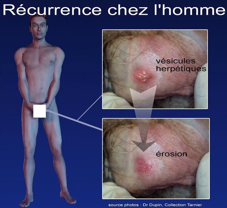 Comment savoir si on a un herpès ?