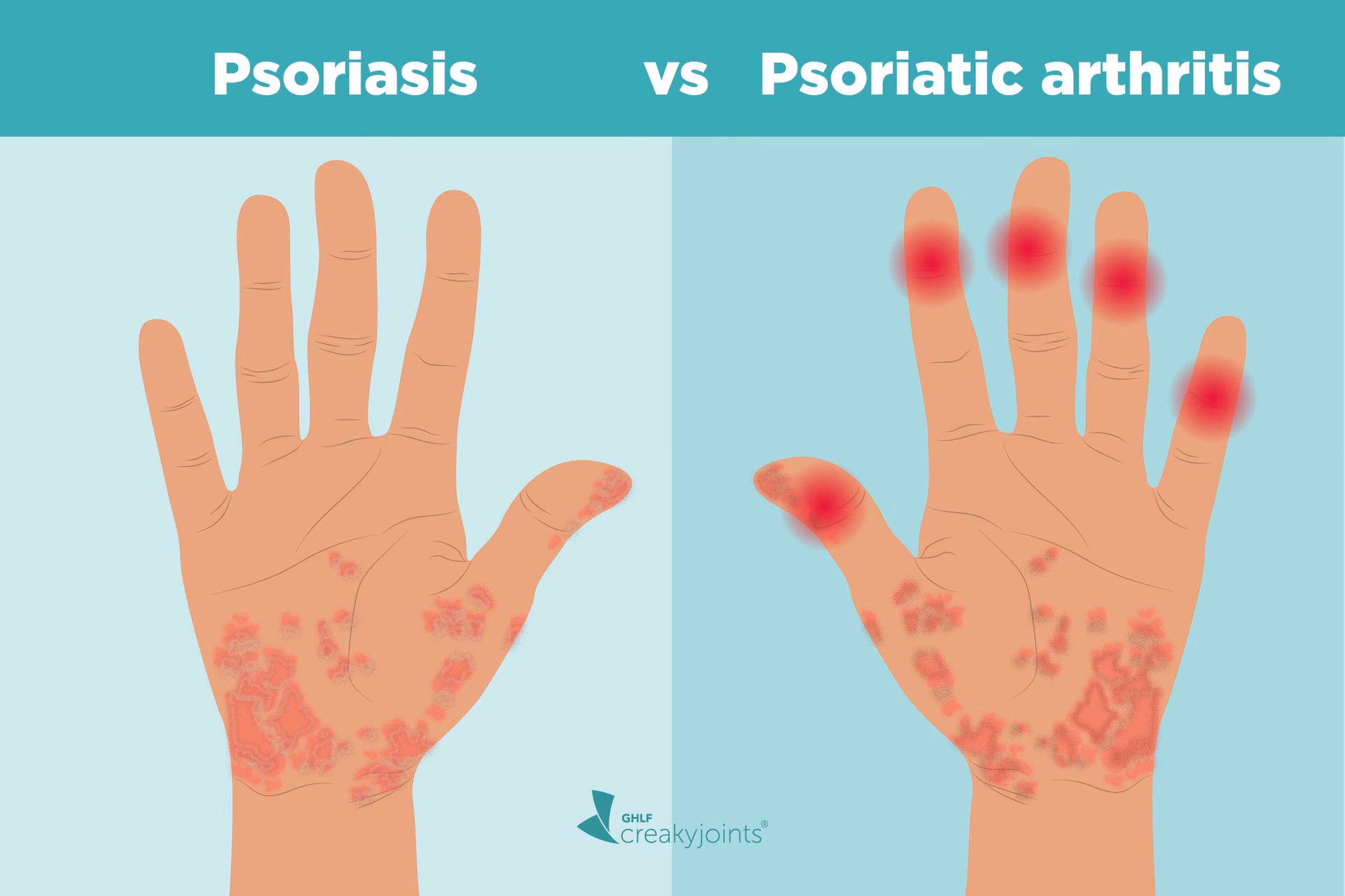 How can psoriasis affect the joints?