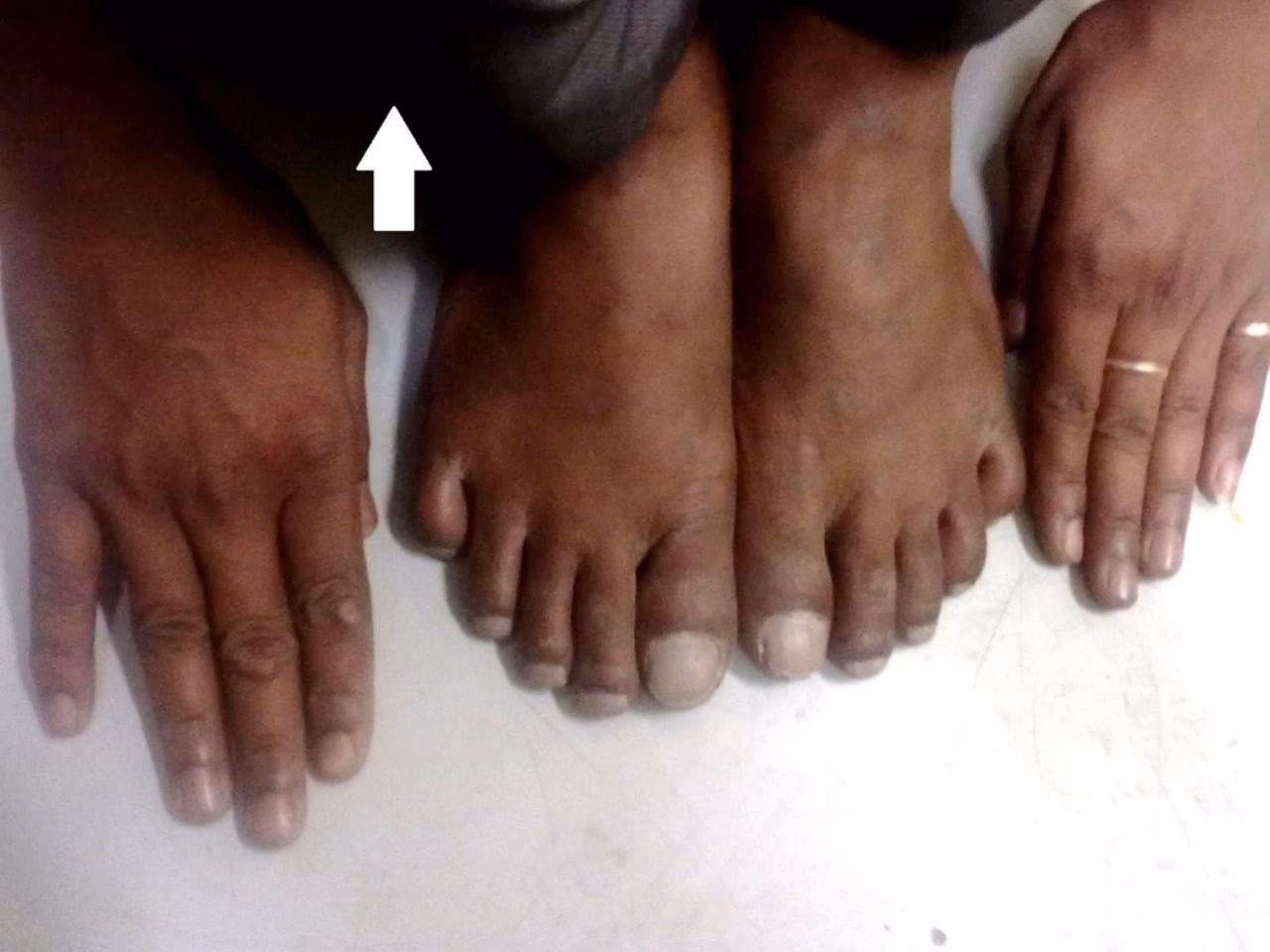 What are the symptoms of a clubbing toe & oedema?