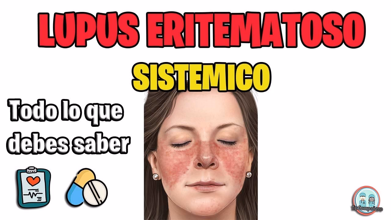 ¿Qué es el lupus sistémico?