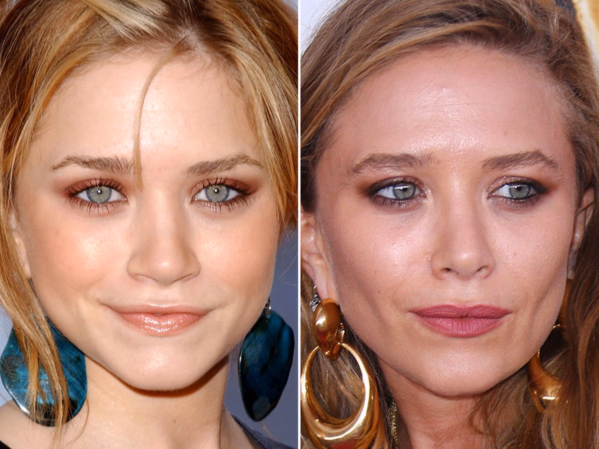 Did Mary-Kate Olsen get plastic surgery?