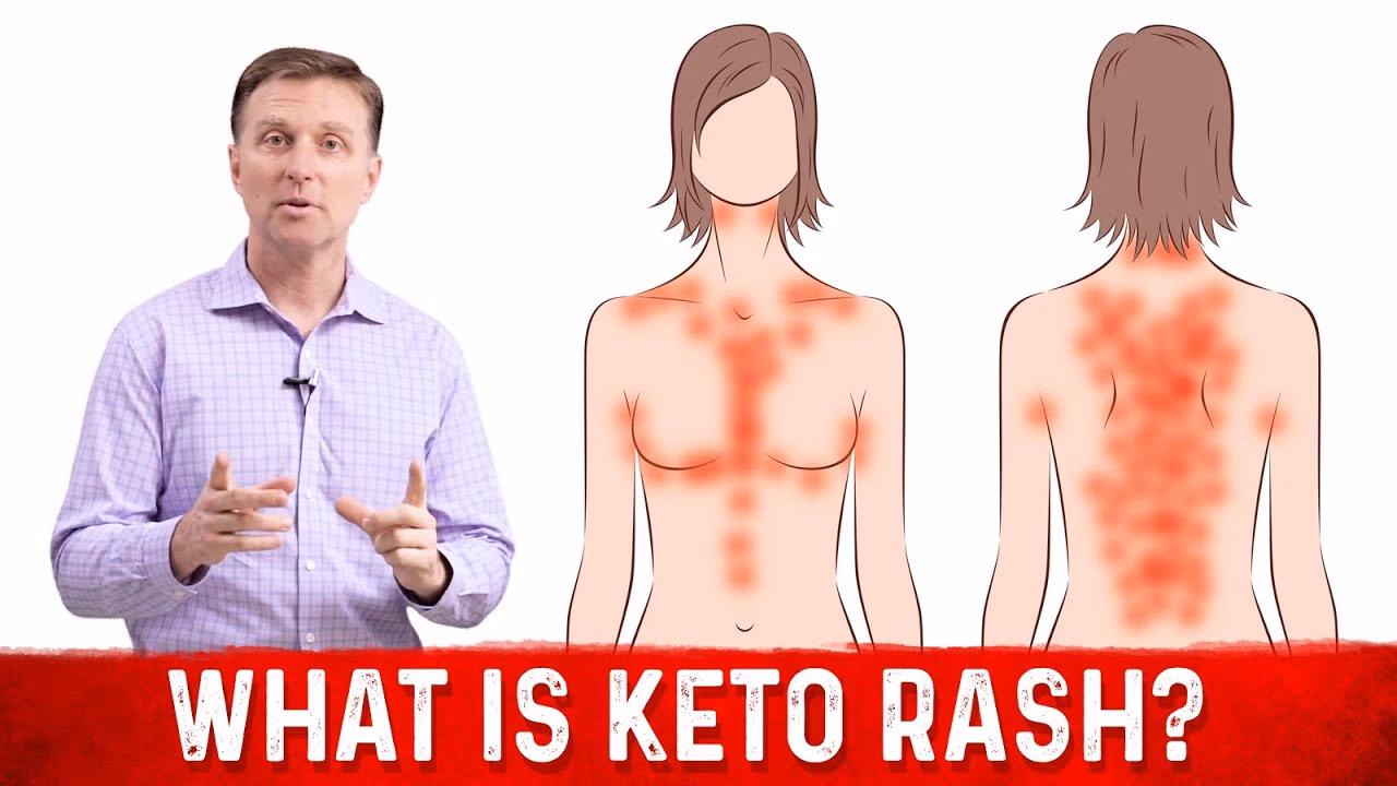 Can fermented foods cause allergies?