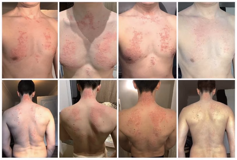 Can fermented foods cause allergies?