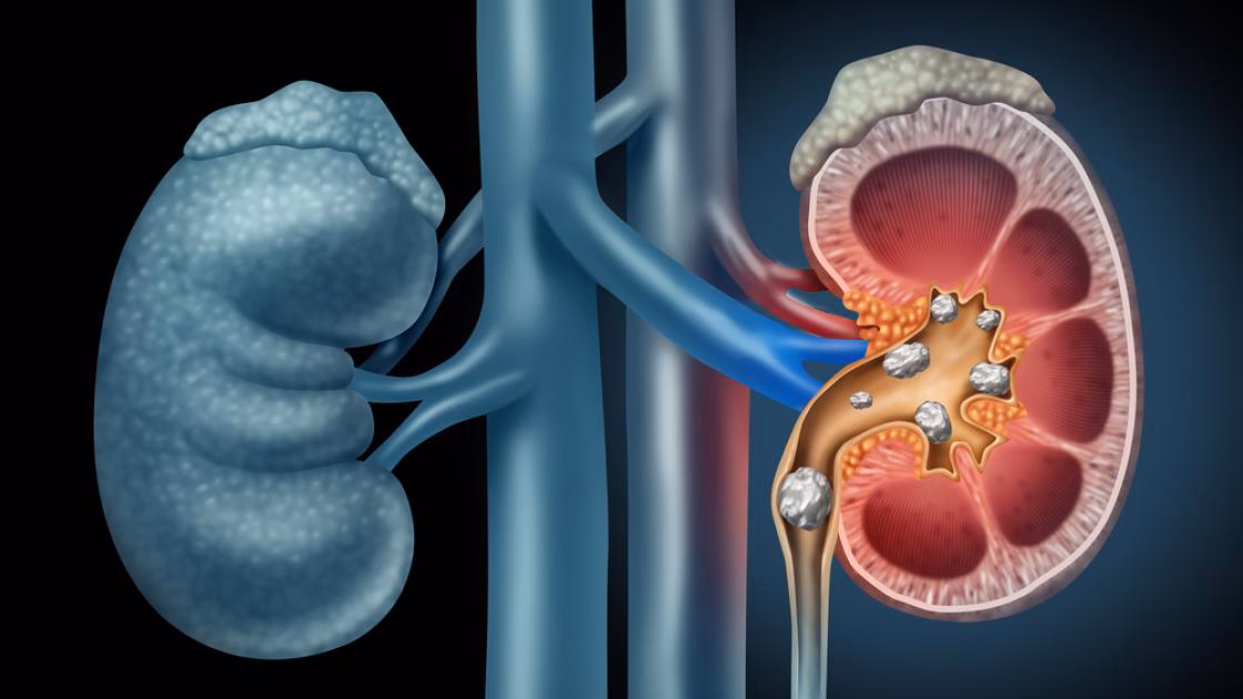 How do kidney stones affect the body?