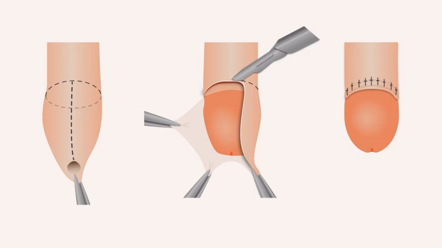 Was kann man gegen Eichel im Urin tun?