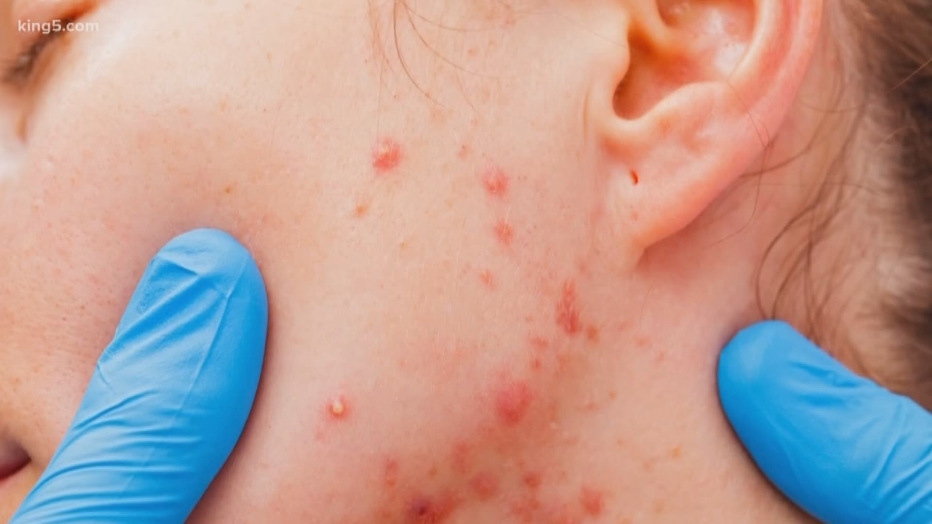 What is the fifth confirmed measles case in Washington?
