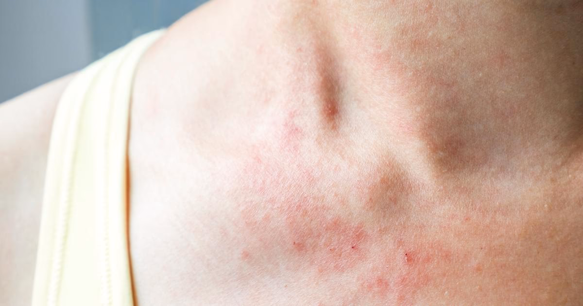 Kann man Kiwis essen wenn man allergisch ist?