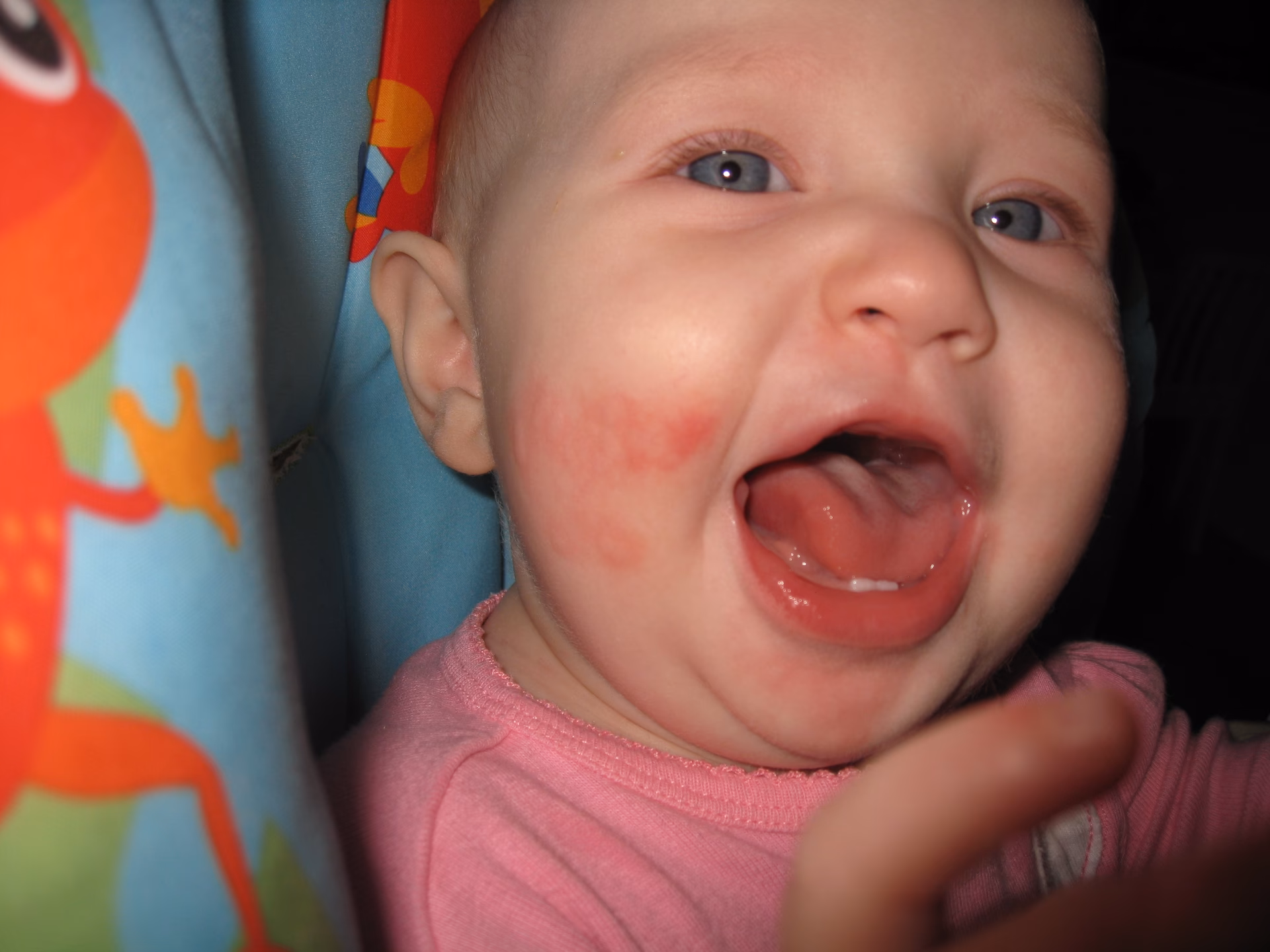 What is kiwifruit allergy?