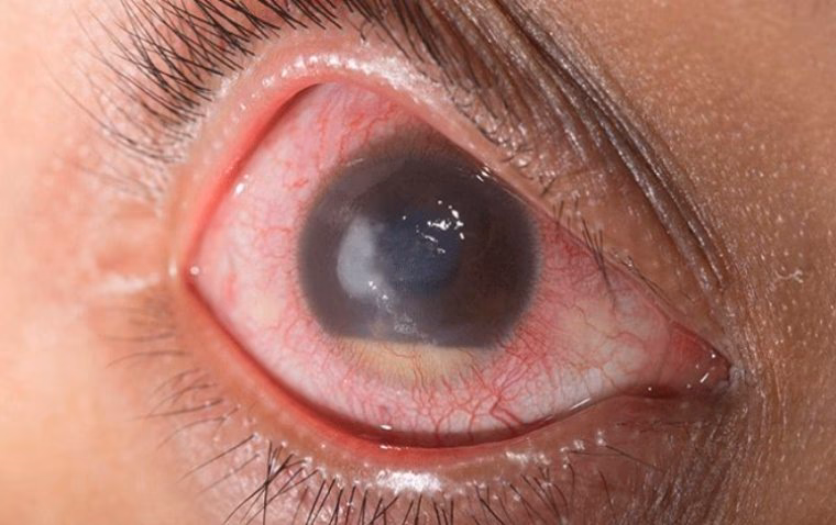 When should I see a doctor for chloramphenicol?