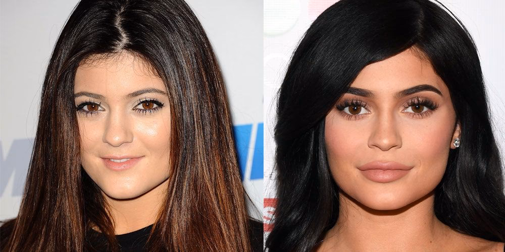 Did Kylie Jenner have jawline surgery?