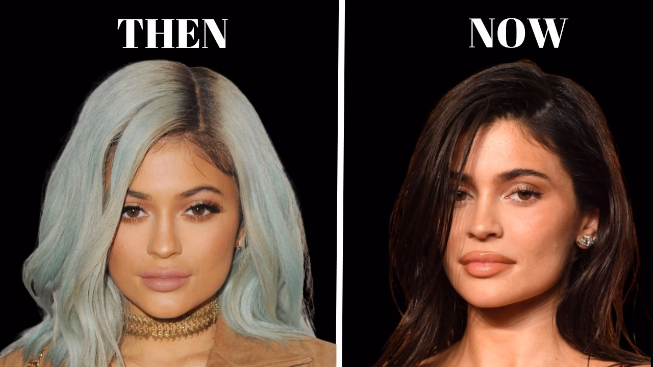Did Kylie Jenner use filler?
