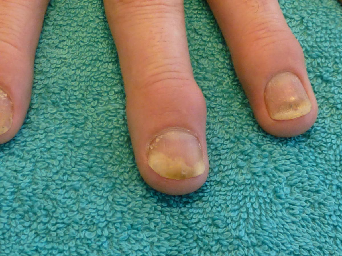 Can psoriasis cause joint changes?