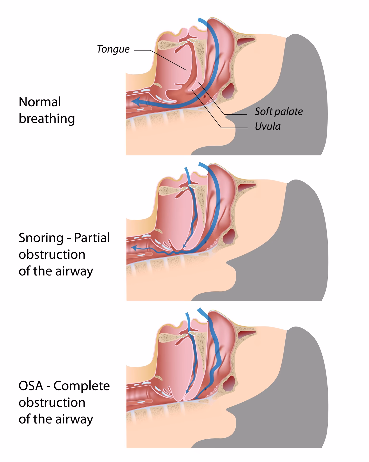 Is labored breathing normal?