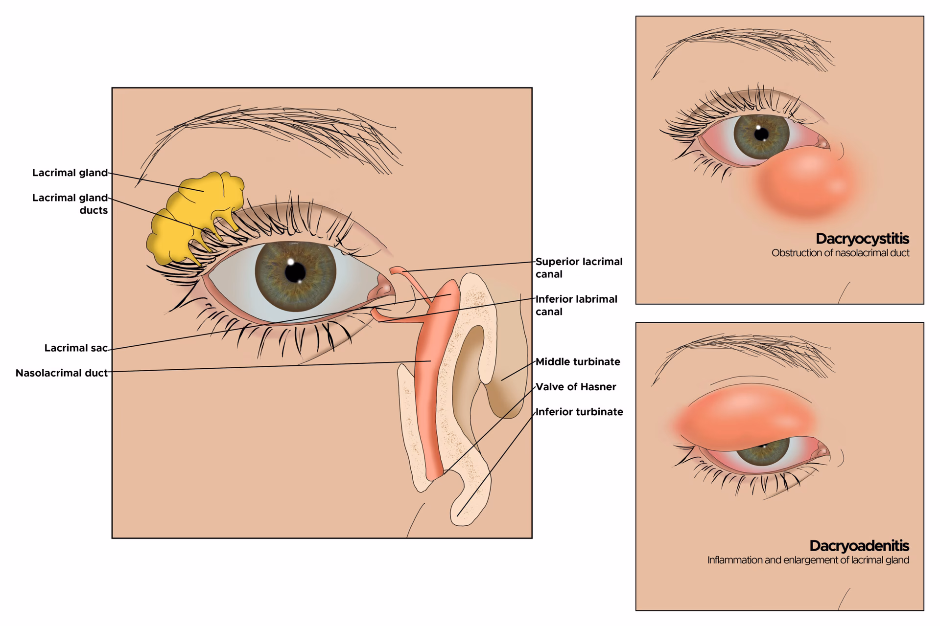 What happens if a lacrimal gland is inflamed?