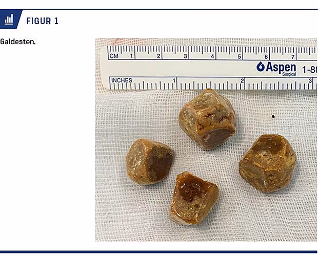 Hvad kan du selv gøre ved galdesten?