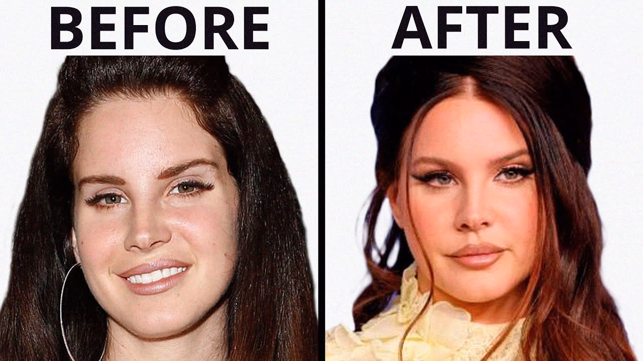 Did Lana Del Rey get a lip flip?