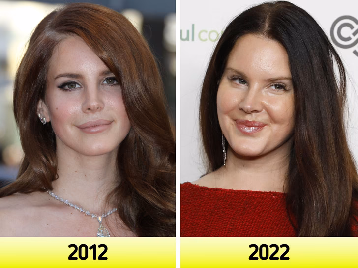 Did Lana Del Rey get a lip flip?