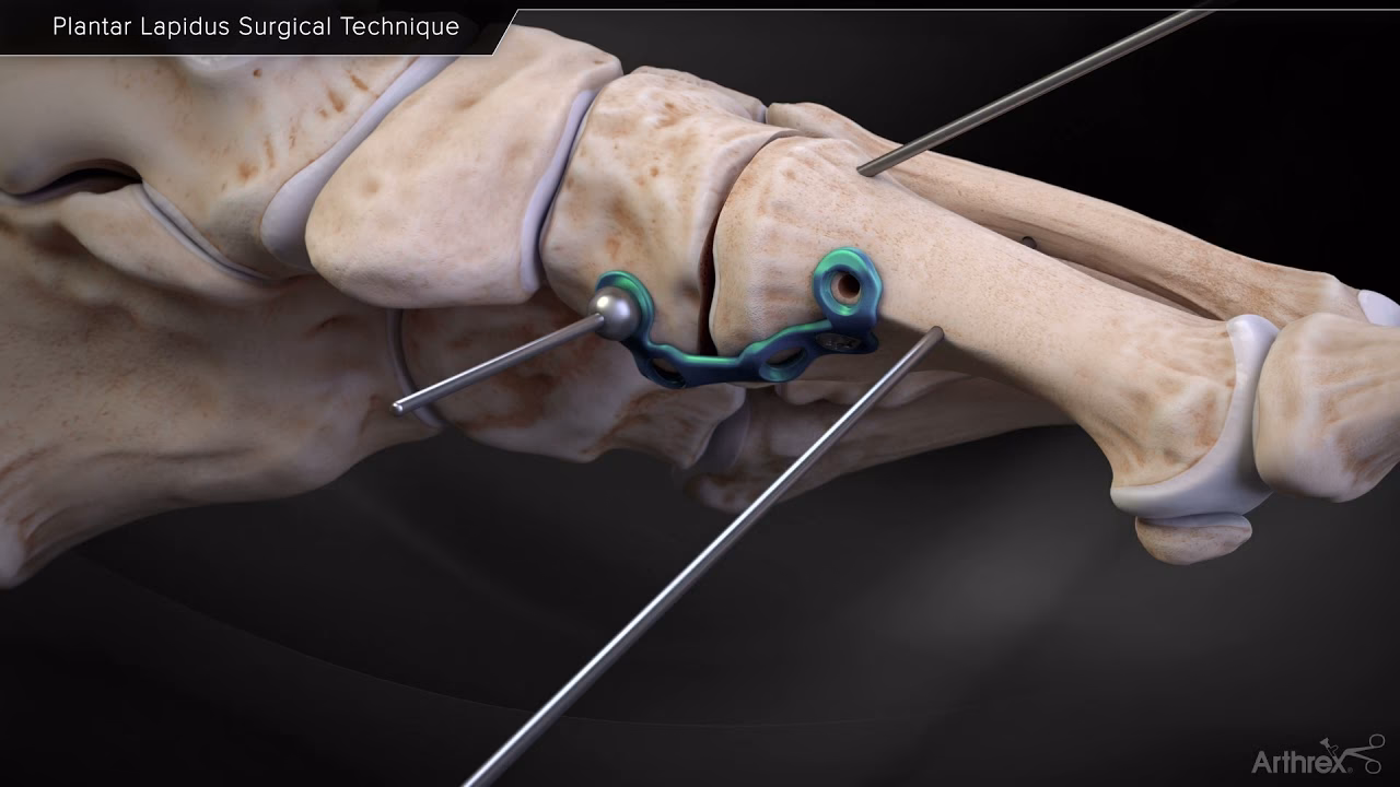 What is lapidus surgery?