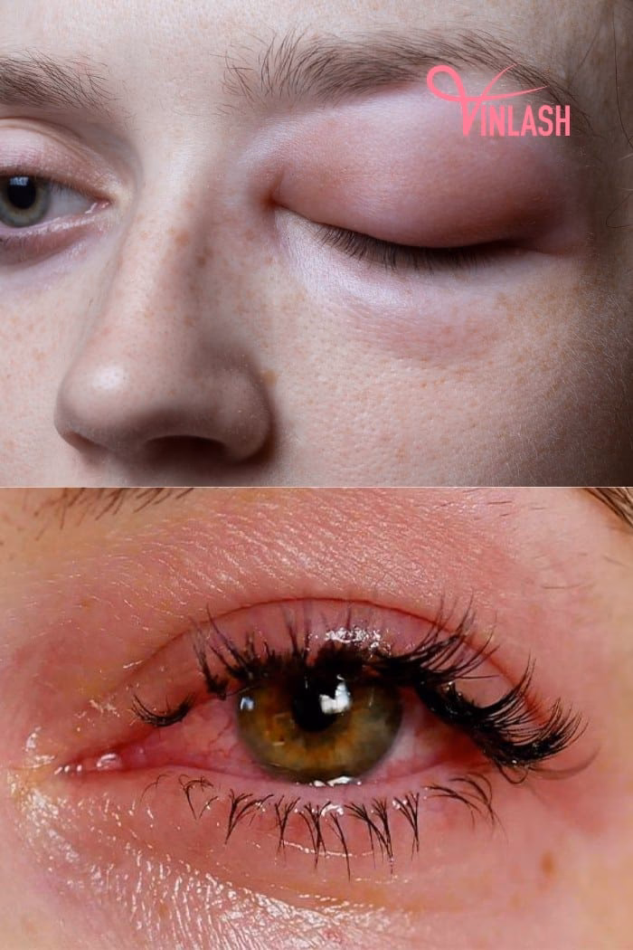 How long does an allergic reaction to eyelash extensions last?