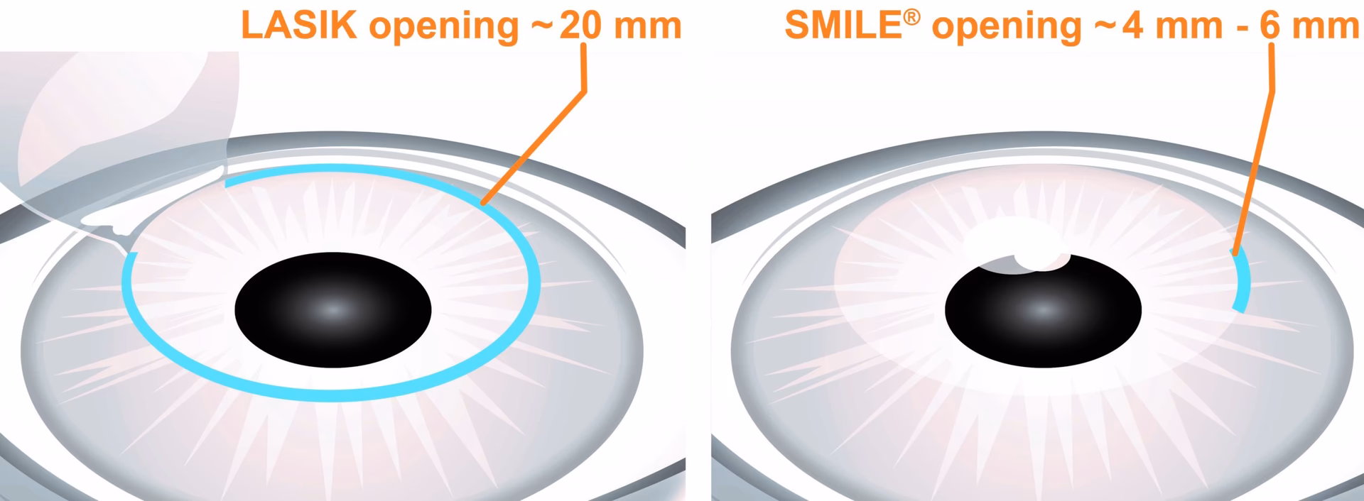 Is LASIK eye surgery worth considering?
