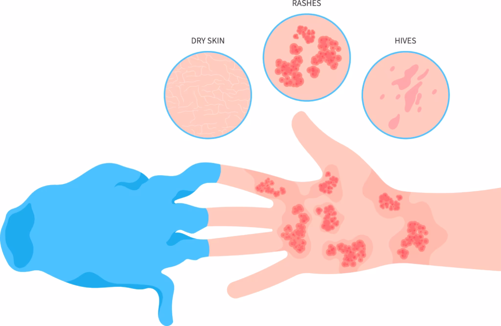 Can a latex allergy cause breathing problems?