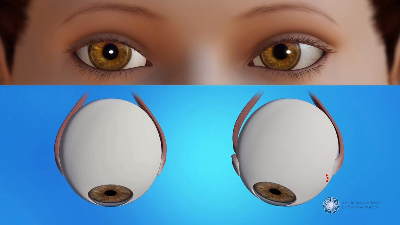 Should I get lazy eye surgery?