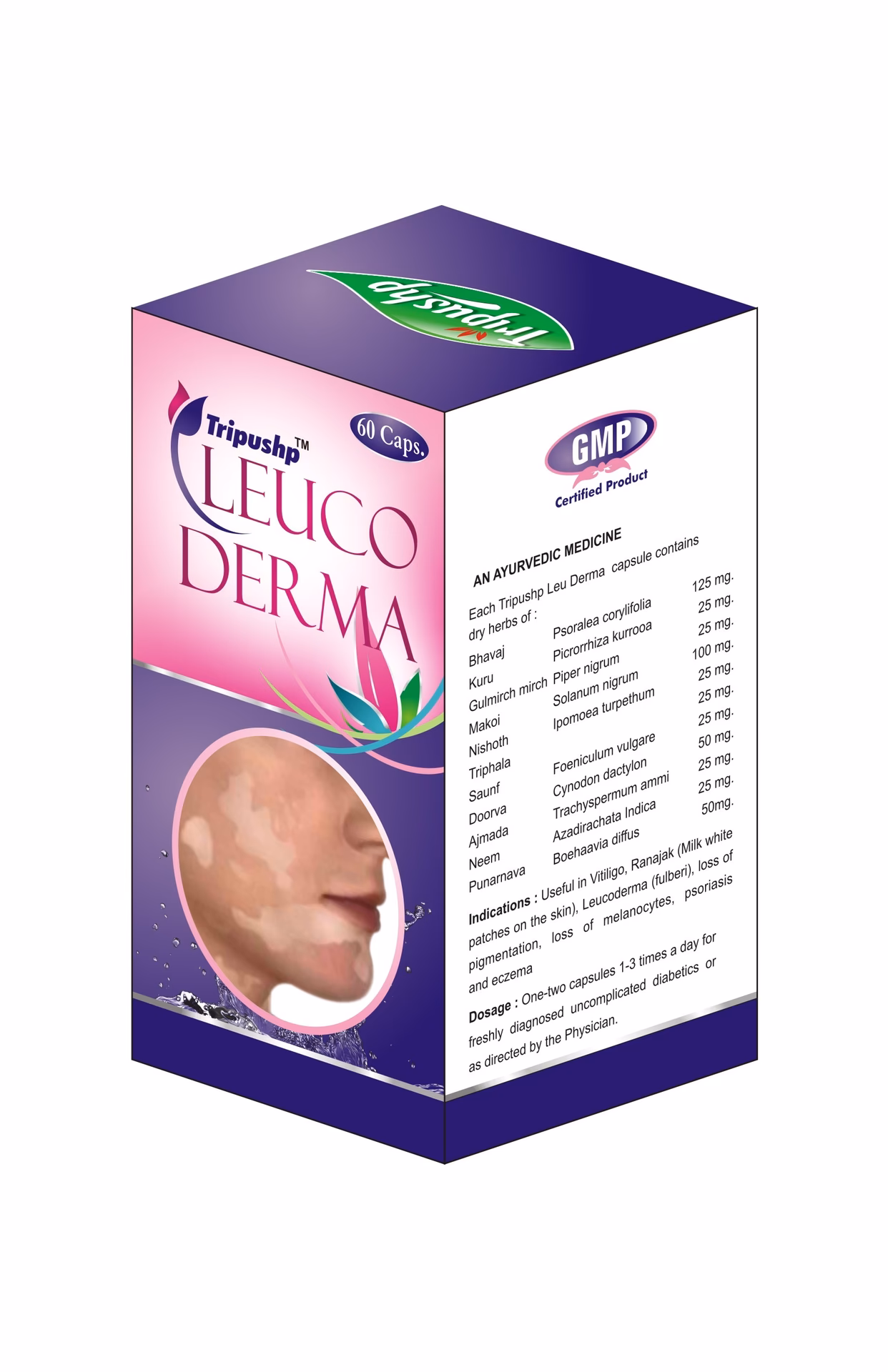 What is vitiligo / leucoderma?