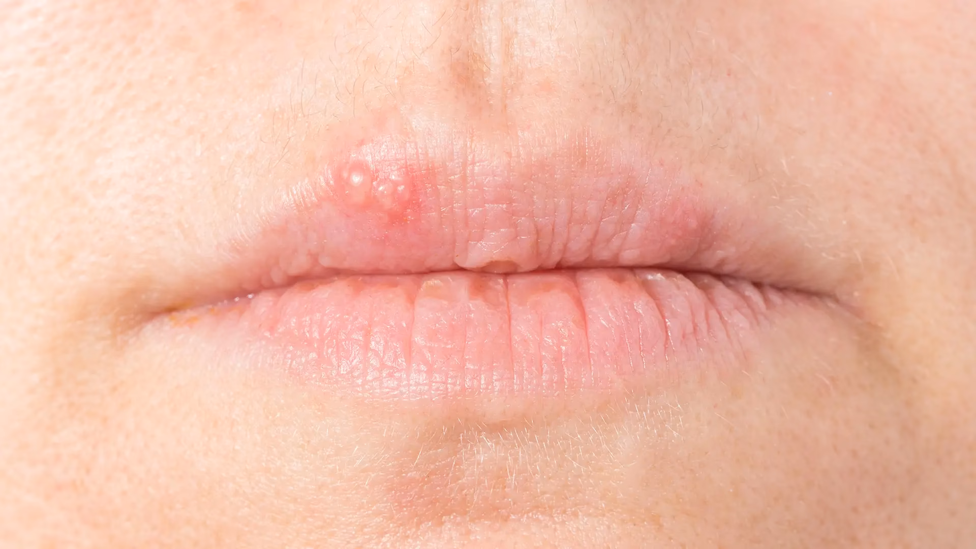 Was ist eine Kontraindikation für Herpes simplex an der Lippe?