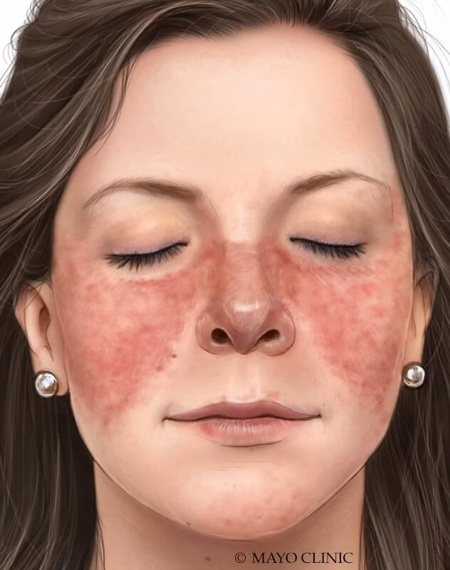 What does lupus skin look like?