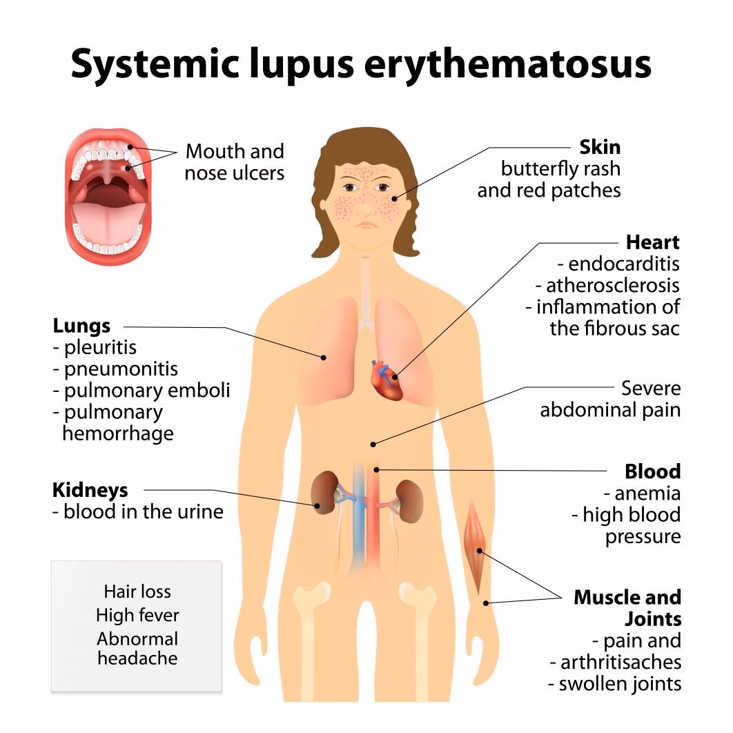 How do you treat lupus flares?