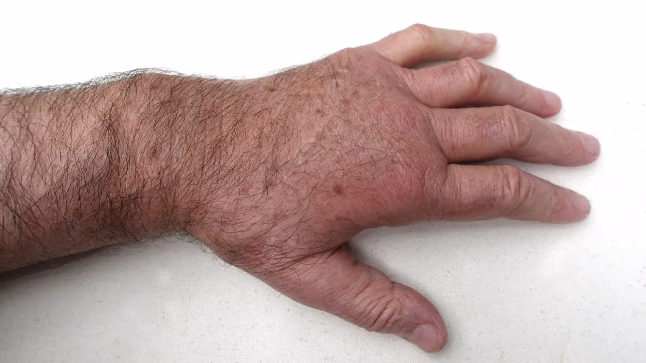Can lupus cause swollen fingers?