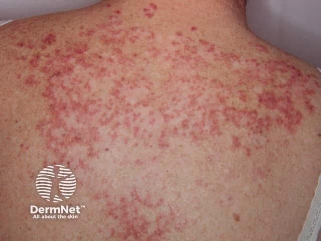 What is l93.1 lupus erythematosus?