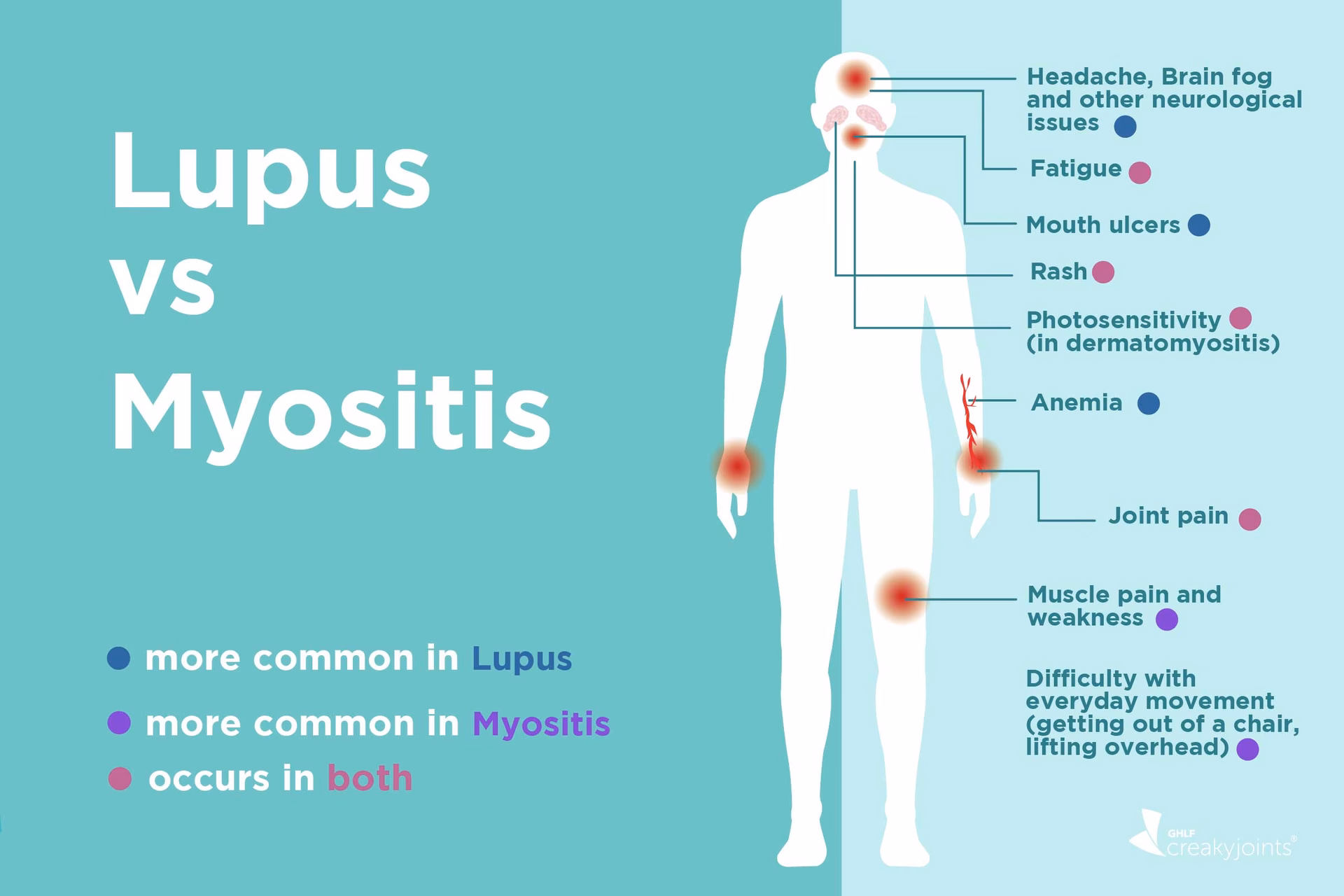 What types of myopathies are associated with lupus?