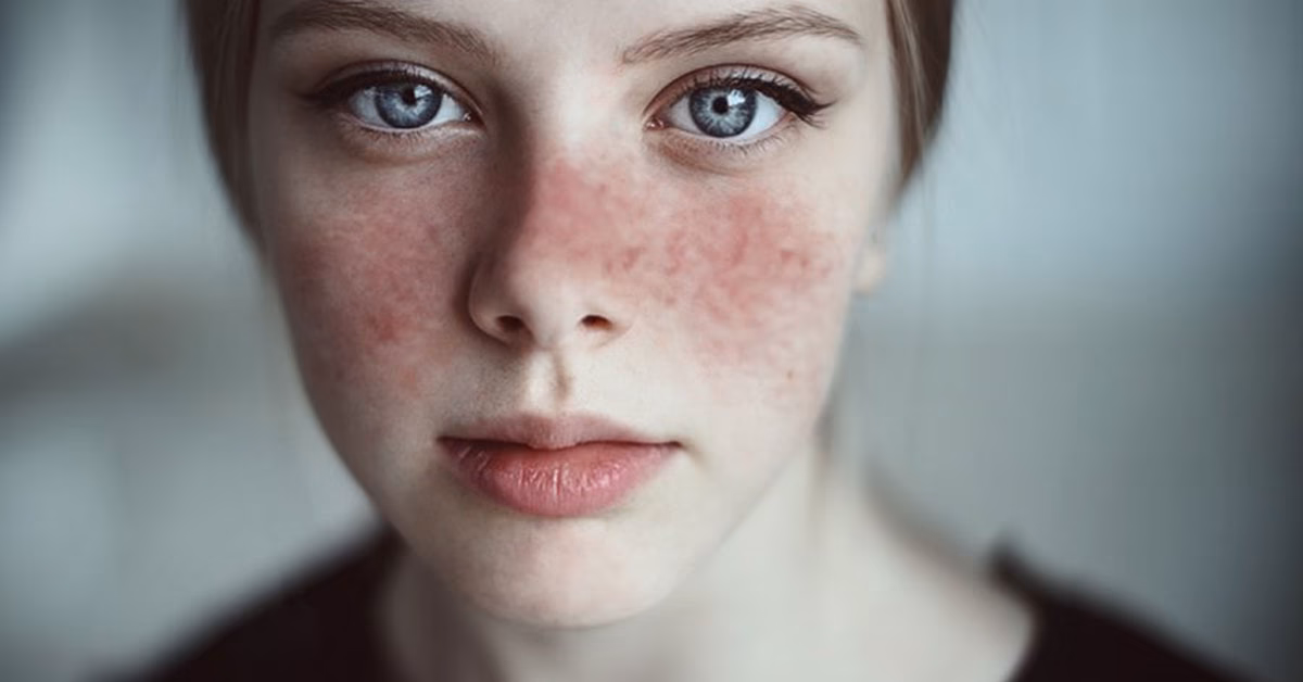 Are sex hormones related to systemic lupus erythematosus (SLE)?